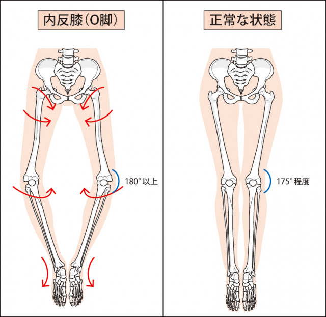 変形性膝関節症の当院でのアプローチは?