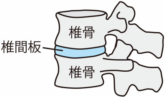 頚椎椎間板ヘルニアとは