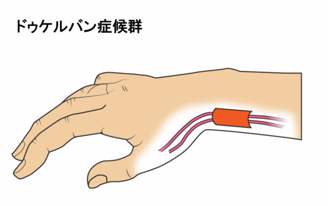 腱鞘炎の画像